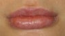 Lip Surgery, Lip Reduction