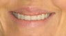 Lip Surgery, Lip Reduction