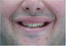 Lip Surgery, Lip Reduction