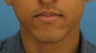 Lip Surgery, Lip Reduction