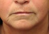 lip lift