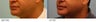Male Upper Lip Reduction