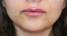 Lip Augmentation