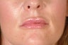 Restylane