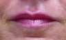 Restylane Injection