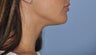 Lip Augmentation