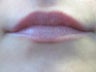 Lip Augmentation
