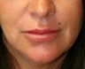 Lip Augmentation with Permalip