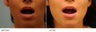 Upper Lip Reduction for Traumatic Lip Deformity