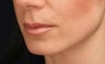 Lip augmentation
