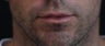 Male lip augmentation