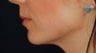 Lip Augmentation