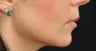 Lip Augmentation