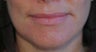 Lip Augmentation