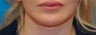 Lip Augmentation