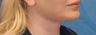 Lip Augmentation
