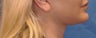 Lip Augmentation