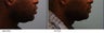 African American Lip Reduction