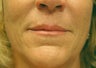 Restylane