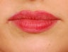 Restylane Lip Augmentation