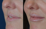 Lip Augmentation