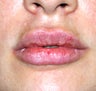 Lip Augmentation