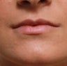 Non Surgical Lip Enhancement