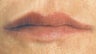 Facial Fillers- Lips