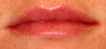 Facial Fillers- Lips