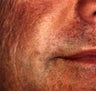 Facial Fillers Male