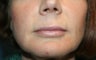 Lip augmentation