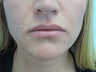 Lip Augmentation with Juvederm