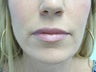 Lip Augmentation with Juvederm