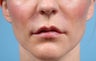 Lip Augmentation
