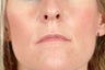 Restylane
