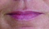Restylane Injection