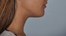 Lip Augmentation