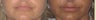 Lip Augmentation