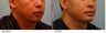 Lip Reduction for Correction of Silicone
