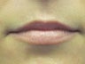 Lip Augmentation