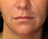 Lip Augmentation with Permalip
