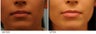 Upper Lip Reduction for Traumatic Lip Deformity
