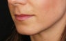 Lip augmentation