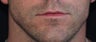 Male lip augmentation