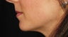 Lip Augmentation