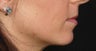 Lip Augmentation