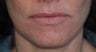 Lip Augmentation