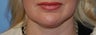 Lip Augmentation