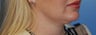 Lip Augmentation