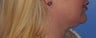 Lip Augmentation